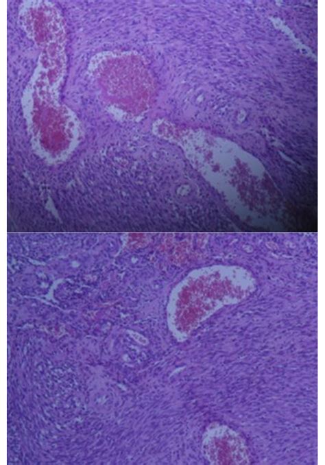 The Lymph Node Is Entirely Erased And Replaced By A Sarcomatous