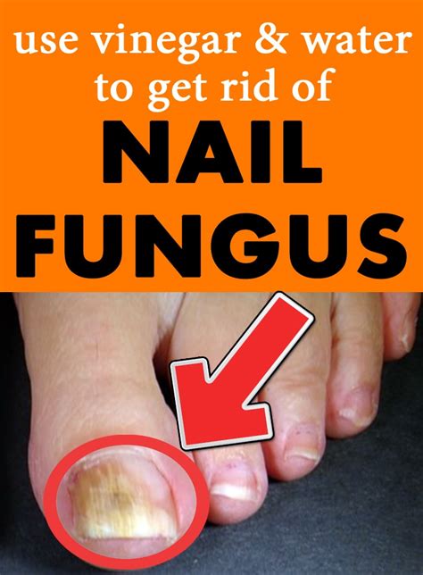 2 Simple & Easy Home Remedies For Nails Fungus - Natural remedies