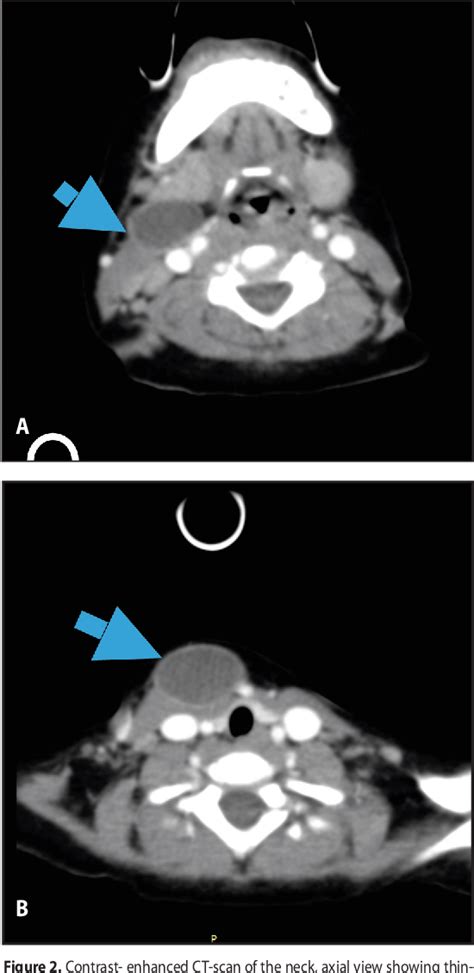 Figure 2 From A Second Branchial Cleft Cyst Presenting As A Dumbbell Shaped Anterior Neck Mass