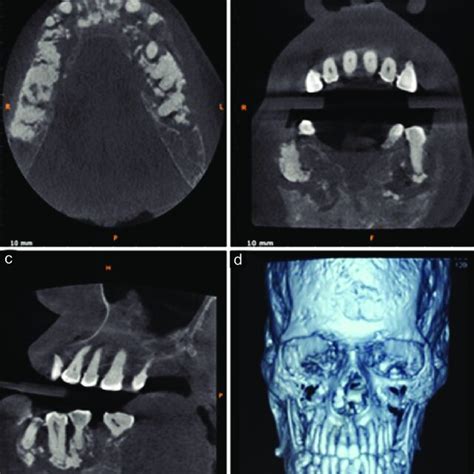 A Cbct Axial Section At The Level Of Root Showing Well Defined