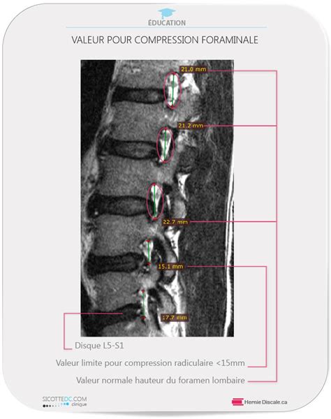 Sténose foraminale lombaire Symptômes Causes