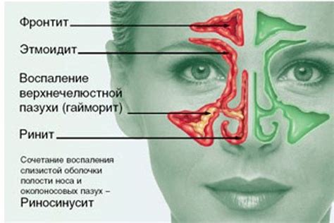 Фронтит: причины и симптомы — "Сенситив"