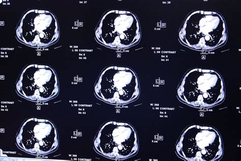 Consiguen predecir respuestas al tratamiento del tumor cerebral