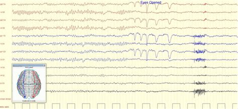 Eeg Reactivity In Coma Atlas Of Science