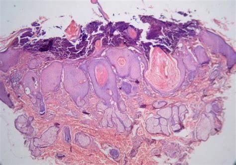 Figure 1 From Multiple Keratoacanthoma A Case Report Semantic Scholar