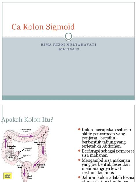 Referat Ca Kolon Sigmoid