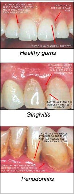 Gum Disease