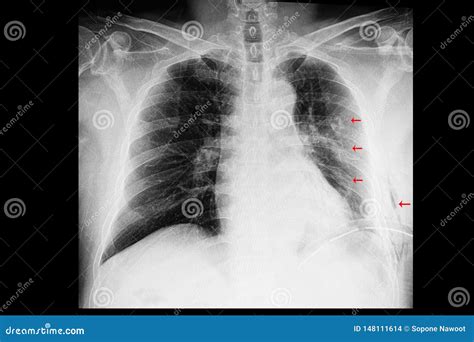 Una Radiograf A Del Pecho De Un Paciente Con Fracturas De La Costilla Y