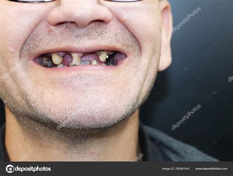 Man Has Rotten Teeth Teeth Fell Out Yellow Black Teeth Stock Photo By