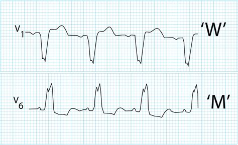 Left Bundle Branch Block LBBB LITFL ECG Library Diagnosis