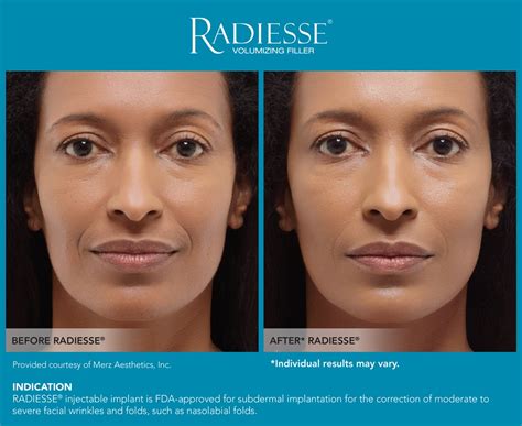 Radiesse Lackawanna Dermatology