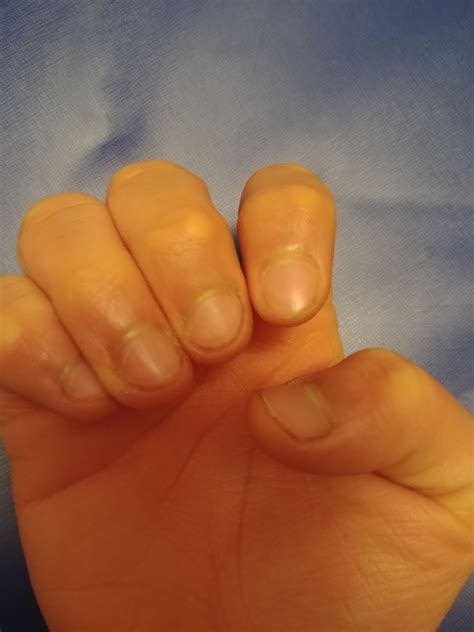 how to prevent hangnails 6