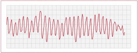 Torsades De Pointes — Medlibes Online Medical Library