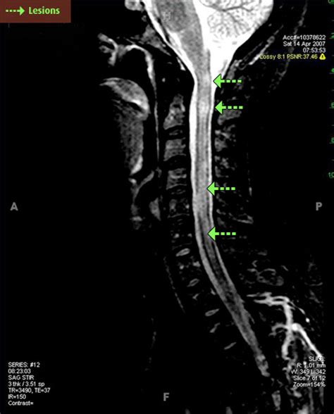 Ms Brain Mri With Contrast