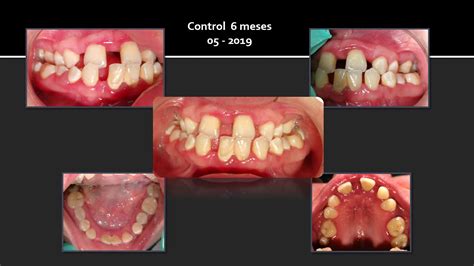 Enfermedad Periodontal En Personas Con S Ndrome De Down Youtube