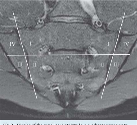 Figure 1 From Magnetic Resonance Imaging Of The Sacroiliac Joints In Patients With Suspected