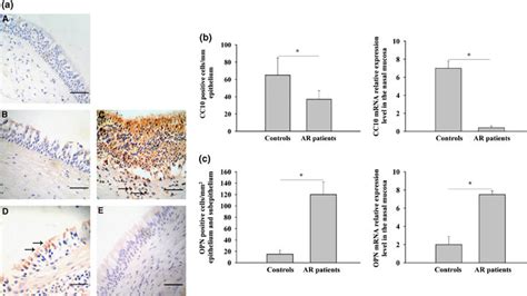 Increased Osteopontin OPN Expression And Decreased Clara Cell 10 KDa