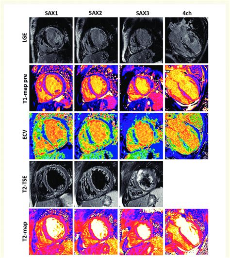 Representative Cardiac Magnetic Resonance Images In Short Axis View And