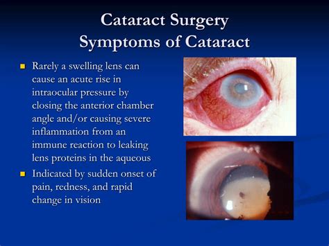 PPT - CATARACT SURGERY PowerPoint Presentation, free download - ID:4867582