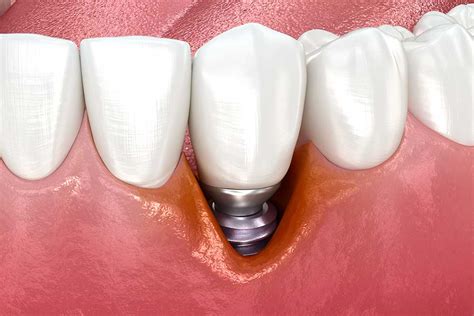 Peri Implantitis Understanding Prevention And Management