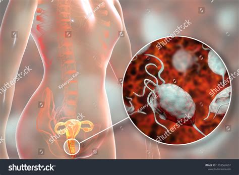 Female Trichomoniasis D Illustration Showing Vaginitis Stock