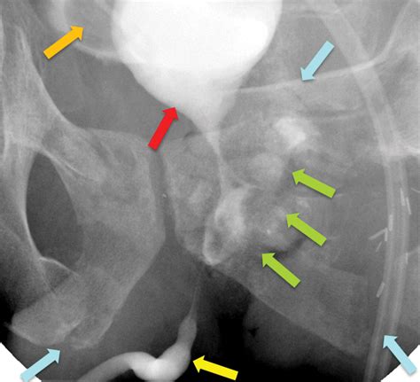 Urethrography For Assessment Of The Adult Male Urethra Radiographics