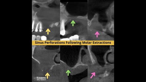 Sinus Perforations Following Teeth Extractions Sinus Perforations