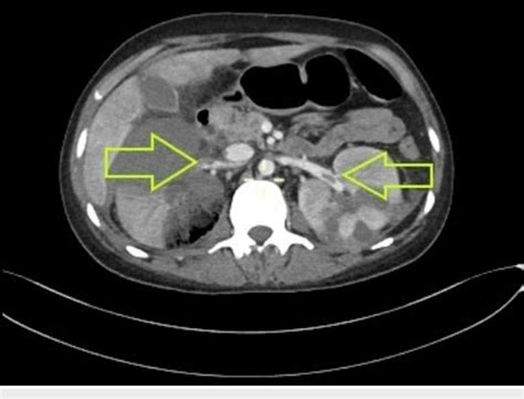 Ct With Contrast Transverse Section Showing Bilateral Renal Vein