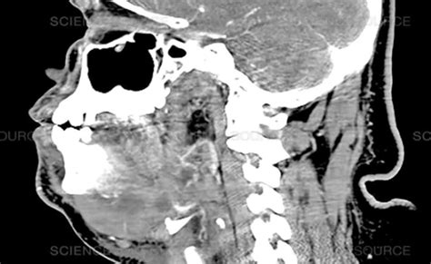 Ludwigs Angina Anatomy