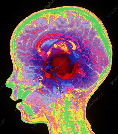 Brain Cancer Mri Stock Image M134 0390 Science Photo Library