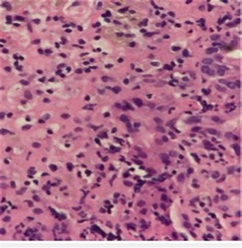 High Power View Of Acute Hepatitis Neutrophilic Infiltration Of