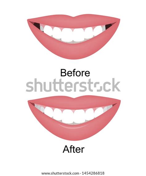 Smile Large Dark Buccal Corridor Before Stock Vector (Royalty Free) 1454286818