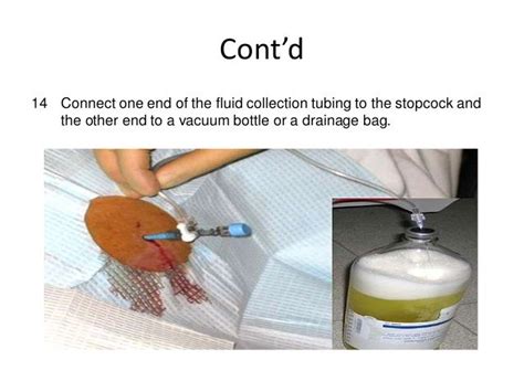 Abdominal Paracentesis