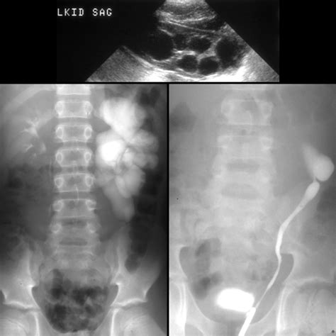 Pediatric Ureteral Valve Pediatric Radiology Reference Article