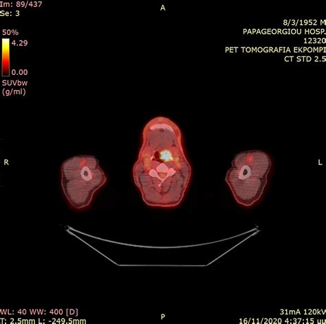 Ileocecal Valve And Cecum Adenocarcinoma Metastatic To The Larynx