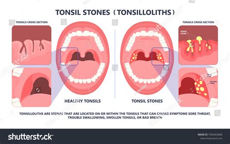 257 Tonsillectomy Images Stock Photos Vectors Shutterstock