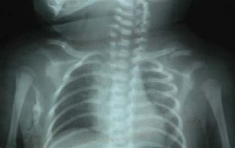 Shoulder Dystocia Xray