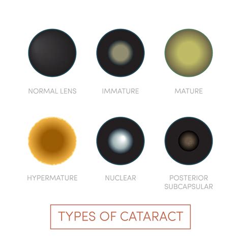 Understanding Cataracts What They Are And How To Treat Them — Grosinger