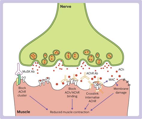 New And Emerging Treatments For Myasthenia Gravis Bmj Medicine