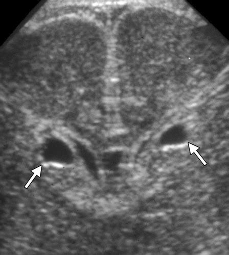 Differential Diagnosis Of Intracranial Cystic Lesions At Head Us