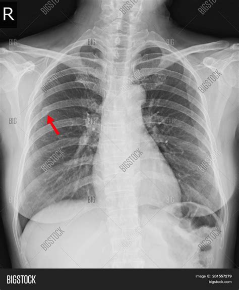 Anatomy Of Ribs And Chest How Many Ribs Do Humans Have Men Women And