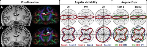 Figure From Mapping The Orientation Of White Matter Fiber Bundles A