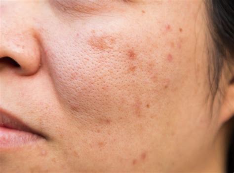 Dicas Para Clarear Manchas De Acne Em Pele Escura Minha Vida