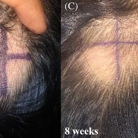 Baseline And Follow‐up Clinical Images 4th 8th And 12th Weeks Of A Download Scientific