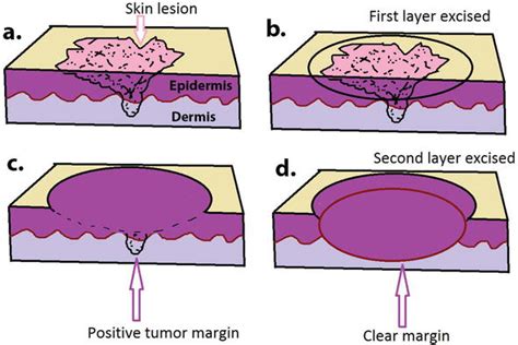 Mohs Micrographic Surgery Intechopen