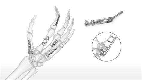 OsteoMed HPS Hand Fusion System Acumed