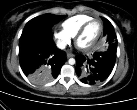 Computed Tomography Pulmonary Angiogram Showing Irregular Filling