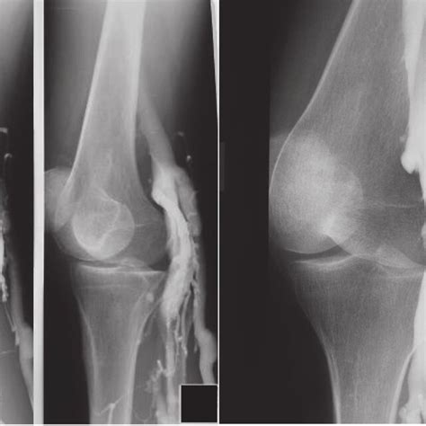 A B Preoperative Venogram Of The Leg Showing No Proximal Dilatation