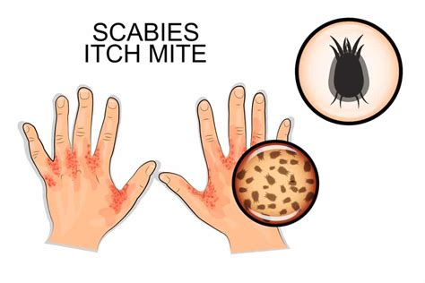 8 Wonderful Home Remedies for Scabies