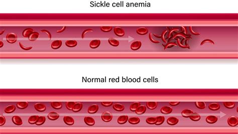 Fda Approves Sickle Cell Disease Treatment That Uses ‘remarkable Gene